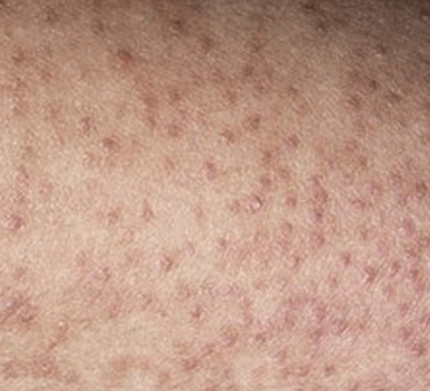 Keratosis Pilaris