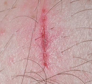 Scars