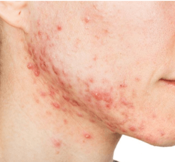 Acne