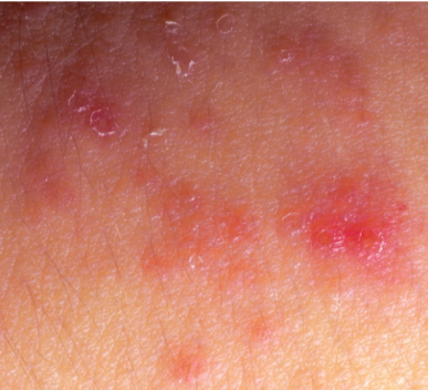 Eczema