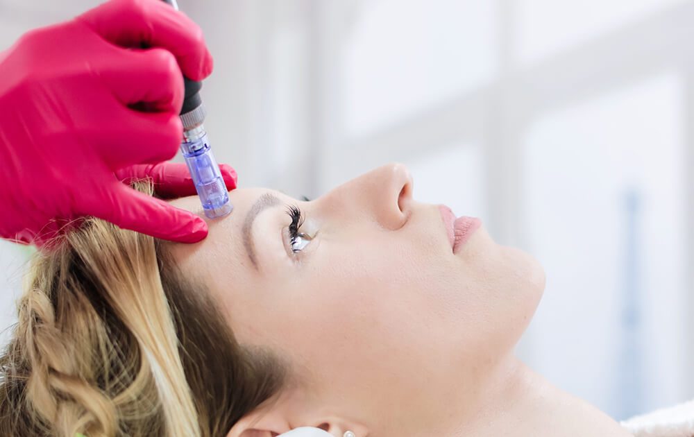 Microneedling