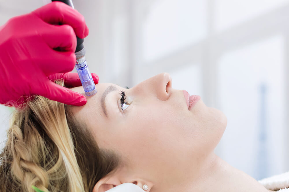 Microneedling
