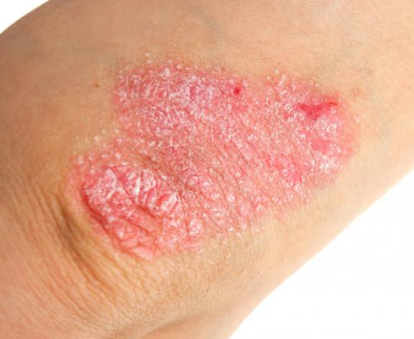 Psoriasis