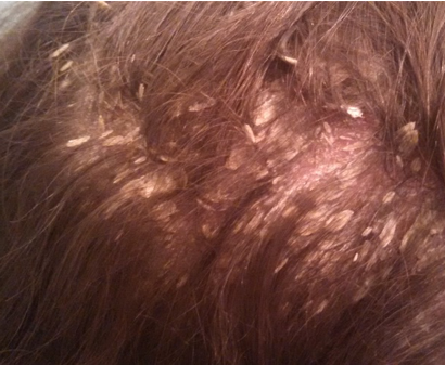 Seborrheic Dermatitis