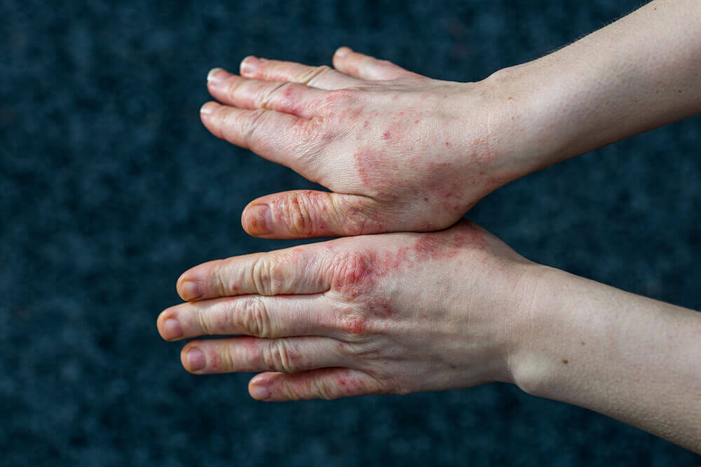 Skin Eruptions and Lesions
