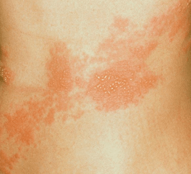 Shingles
