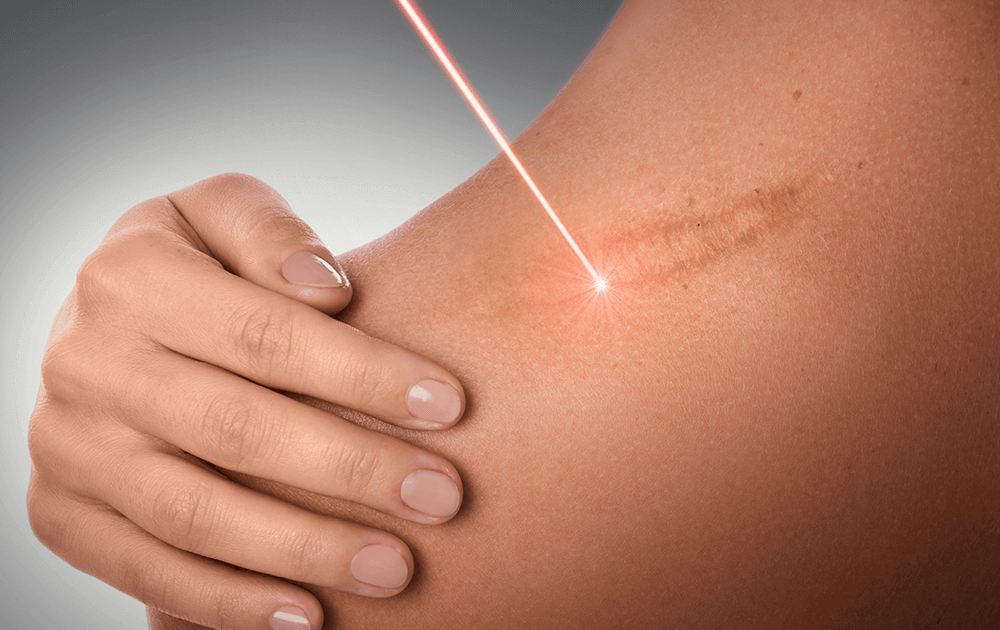 Scar Removal