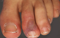 Acral Ischemia