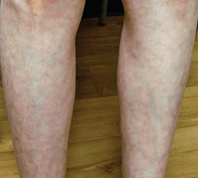 Livedo Reticularis