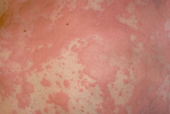 Uritcaria