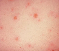 Vesicular