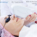 IPL treatment female patient