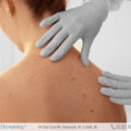 dermatologist checking patient's moles