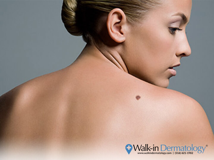 Walk-in Dermatology - How to Deal with a Pimple within a Mole