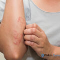 Eczema | Walk-in Dermatology