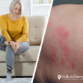 Lingering Covid Skin Conditions