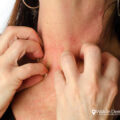 What you Should Know about Silver and Nickel Allergies