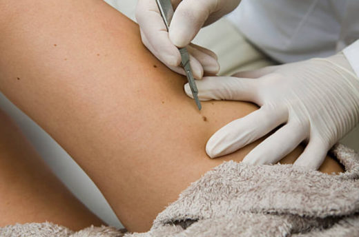 Skin Cancer Excision Surgeries | Walk-in Dermatology