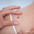 Climate Change Skin Cancer