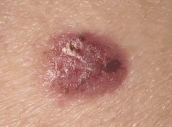 carcinoma