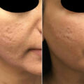 before and after photo of a patient's face after an RF microneedling session