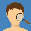 Illustration of a Man with Acne