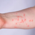 Monkey Pox on someone's arm