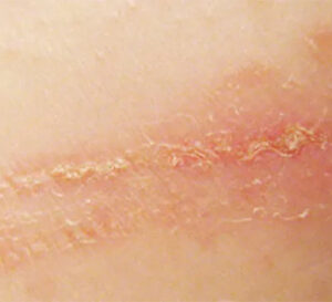 Contact Dermatitis