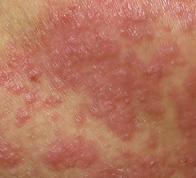 Fungal infection