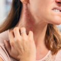a woman scratching a rash on her neck