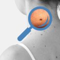 Melanoma Blog Image